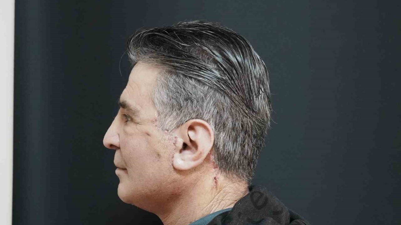 Bitlis'te bir ilk: Yüz germe ameliyatı başarıyla gerçekleştirildi