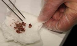 Elazığ’da estetik ameliyatında inanılmaz olay: Burunda taş çıkarıldı