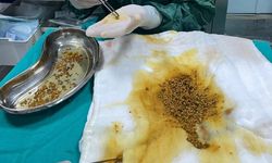 Doktorlar bile hayrete düştü: Tek hastadan 2.067 safra taşı çıkarıldı