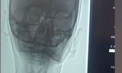 Iğdır'da şah damarı darlığına stentli müdahale edildi