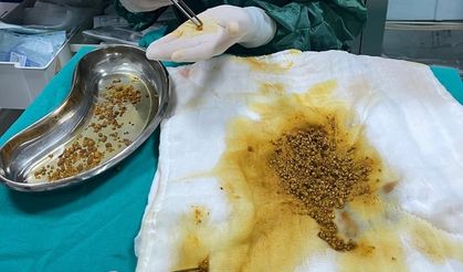 Doktorlar bile hayrete düştü: Tek hastadan 2.067 safra taşı çıkarıldı