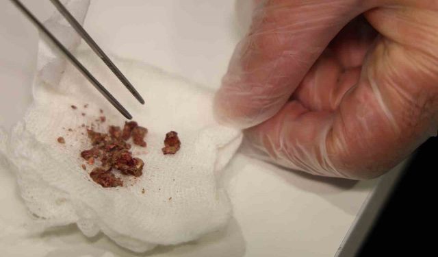 Elazığ’da estetik ameliyatında inanılmaz olay: Burunda taş çıkarıldı