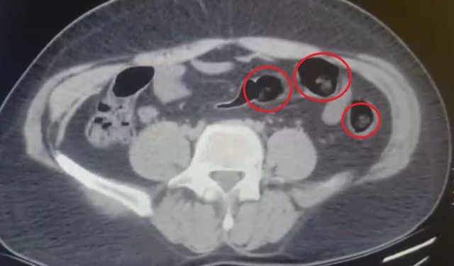 Otobüste durduruldu, midesinden 502 gram metamfetamin çıktı