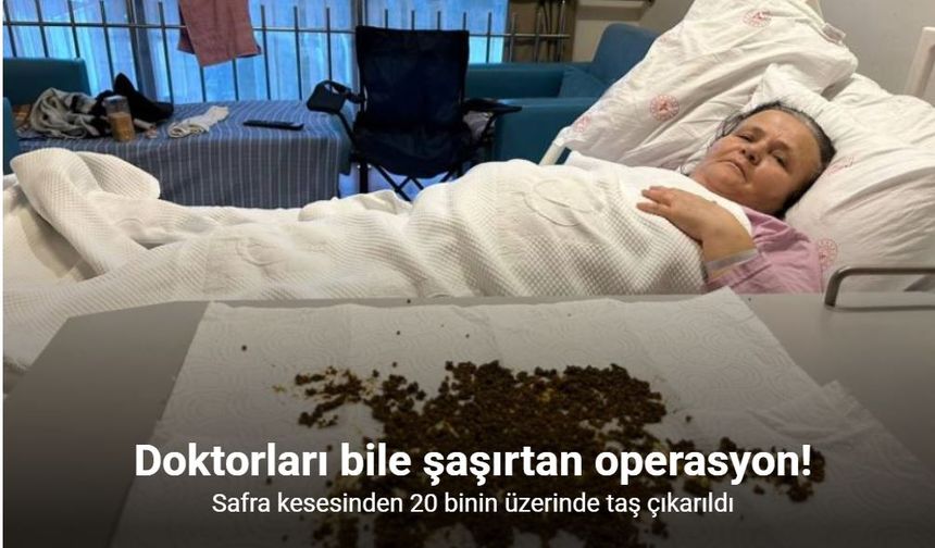 Safra kesesinden 20 binin üzerinde taş çıkarıldı